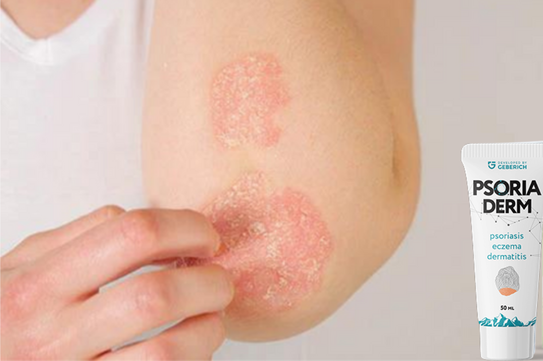 PSORIA DERM PSORIA DERM
