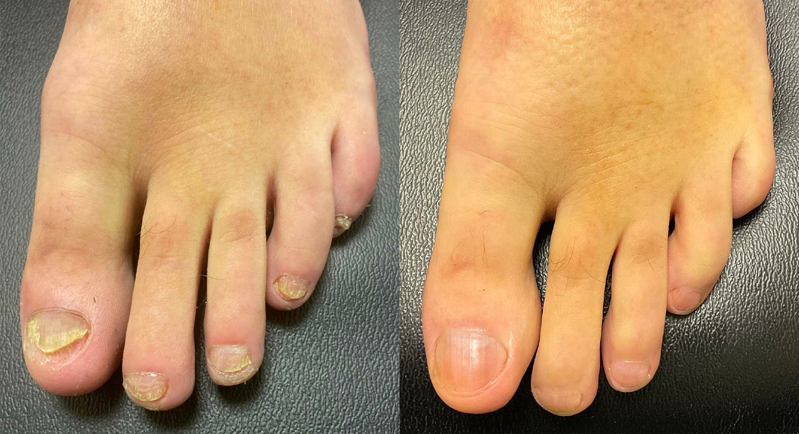 Toenail-Fungus-Before-and-After-Photo-by-Oregon-Institute-of-Foot-Care-in-Lake-Oswego-OR-7.jpg