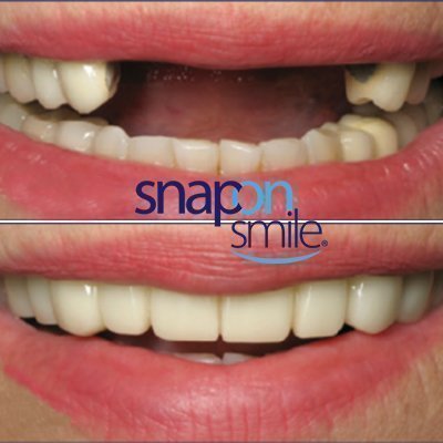 snap-on-smile-img1-1-2.jpg