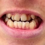 snap-on-smile-5-1-2.jpg
