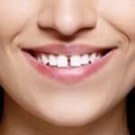 snap-on-smile-6-1-1.jpg